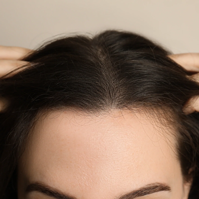 Does Hair Transplant Work for Women? 1 Does Hair Transplant Work for Women?