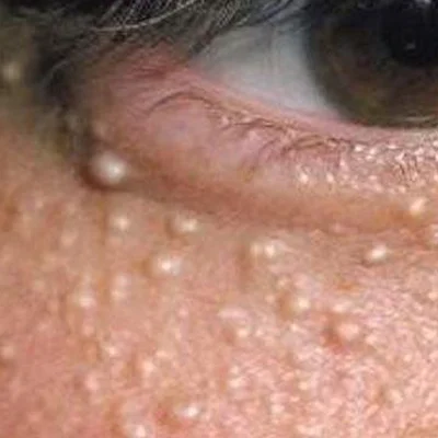 How Do Dermatologists Remove Milia