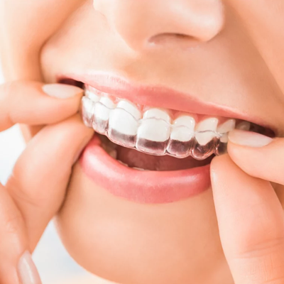 How Long Do I Have to Wear Retainers? 1 How Long Do I Have to Wear Retainers?