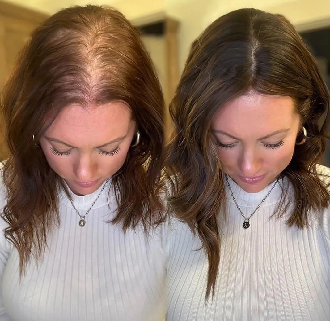 Dynamic Life Clinics - Hair Loss Treatment - Before & After