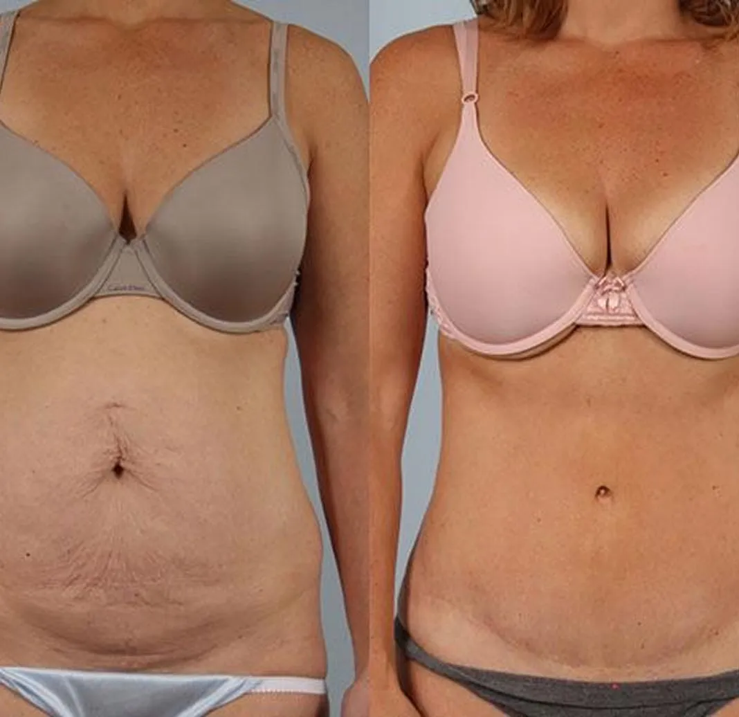 Dynamic Life Clinics - Liposuction - Before & After