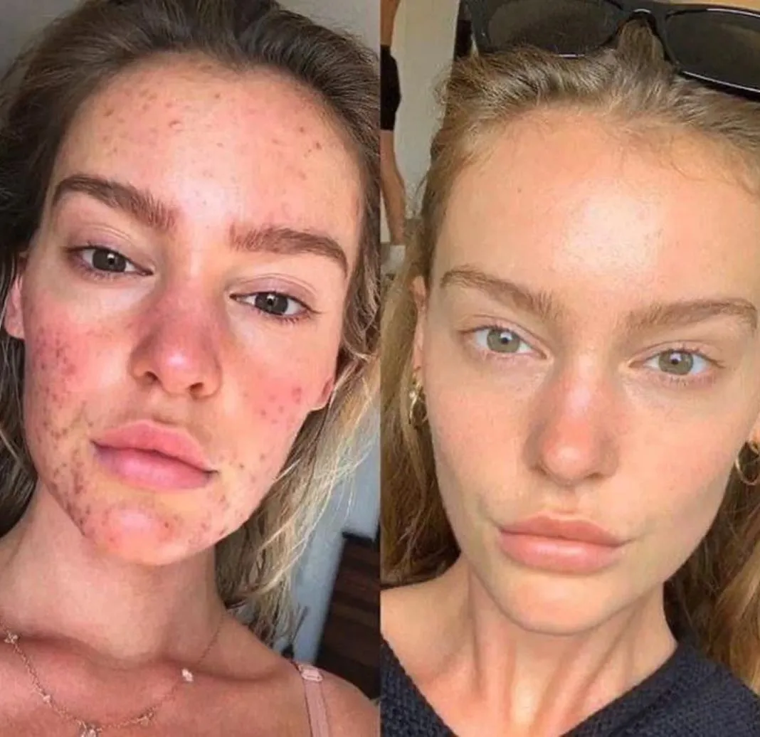 Dynamic Life Clinics - Acne Treatment - Before & After