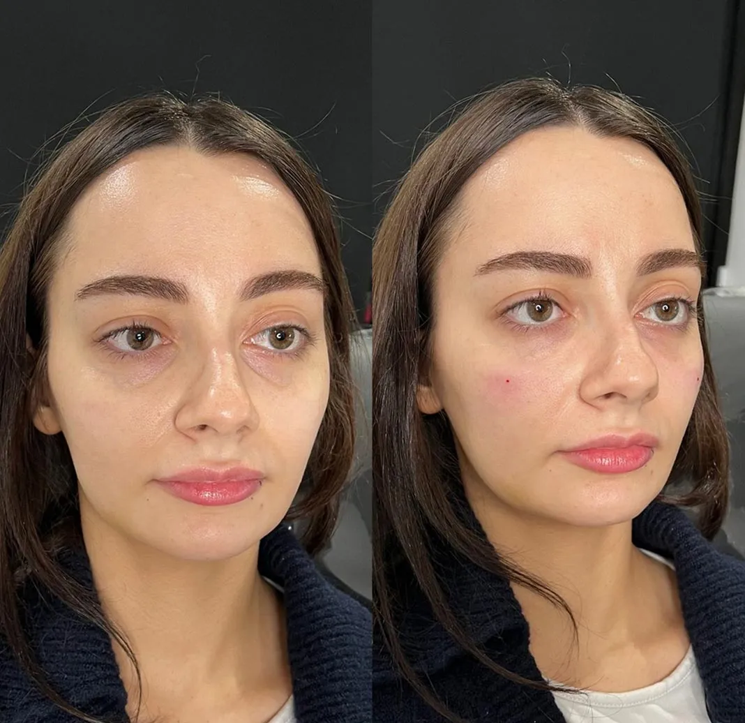 Dynamic Life Clinics - Dermal Fillers Injections - Before & After
