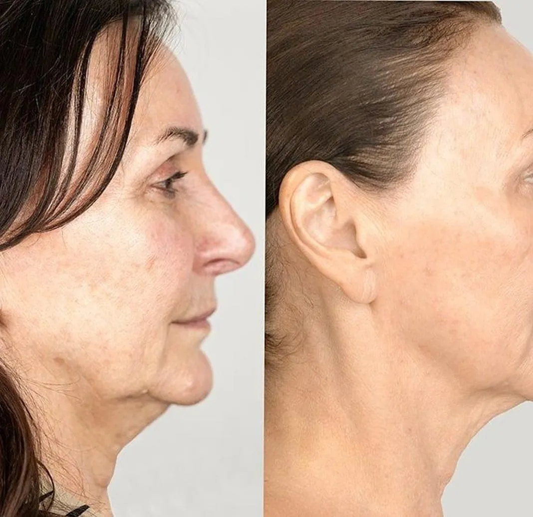 Dynamic Life Clinics - Chin Liposuction - Before & After