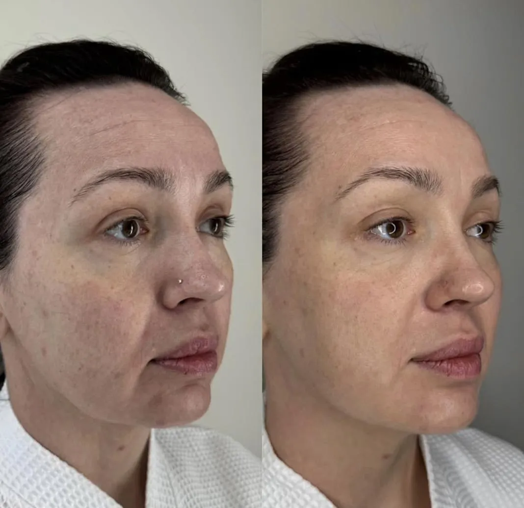Dynamic Life Clinics - Skin Whitening - Before & After