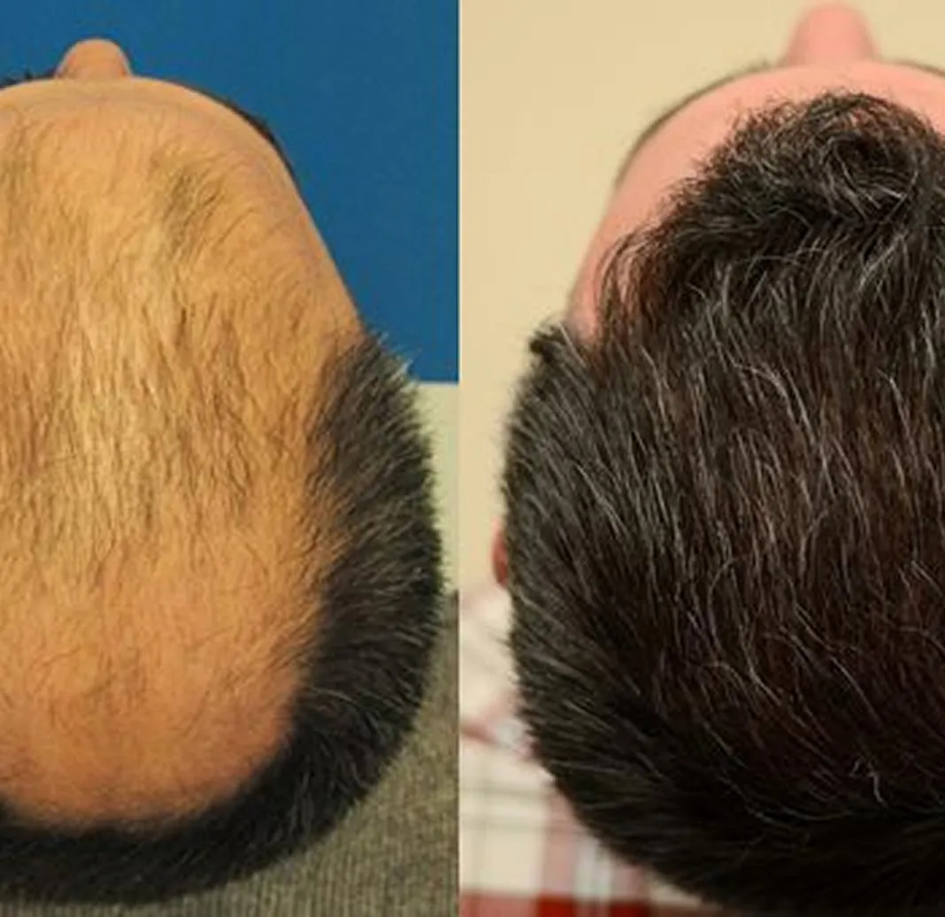 Dynamic Life Clinics - Hair Transplant - Before & After