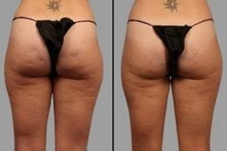 Before & After Cellfina Treatment in Dubai
