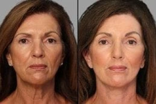 Fine Lines and Wrinkles Removal 4 Before & After Fine Lines and Wrinkles