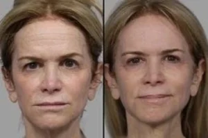Fotona TwinLight® Fractional Rejuvenation 4 Before & After Fotona Twinlight Fractional Rejuvenation
