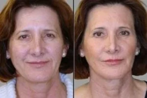 Fotona TwinLight® Fractional Rejuvenation 6 Before & After Fotona Twinlight Fractional Rejuvenation in Dubai