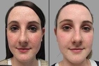 Freckles and Blemishes 6 Before & After Freckles and Blemishes in Dubai