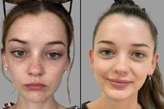 Freckles and Blemishes 4 Before & After Freckles and Blemishes