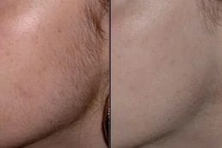 Laser Hair Bleaching 4 Before & After Laser Hair Bleaching