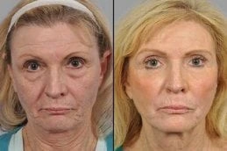 Before & After Laser Skin Tightening in Dubai