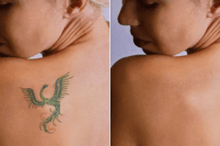 Before & After Laser Tattoo Removal