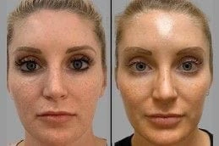 Micro Needling with PRP Therapy 6 Before & After Micro Needling PRP Therapy in Dubai