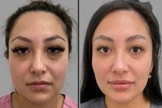 Micro Needling with PRP Therapy 5 Before & After Micro Needling PRP Therapy