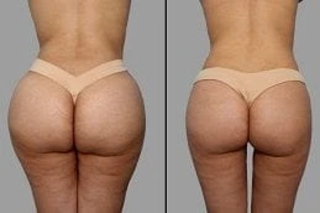 Non Surgical Bum Lift Dubai 4 Before & After Non Surgical Bum Lift