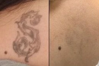 Before & After Picosure Laser Tattoo Removal