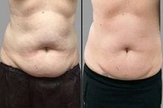 SculpSure Body Contouring 4 Before & After SculpSure Body Contouring
