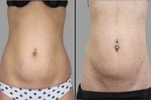 Before & After Stretch Marks Removal