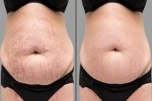 Before & After Stretch Marks Removal in Dubai