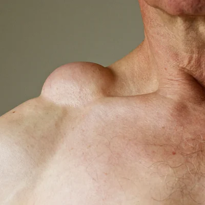 Can Lipomas Be Removed Without Surgery? 1 Can Lipomas Be Removed Without Surgery