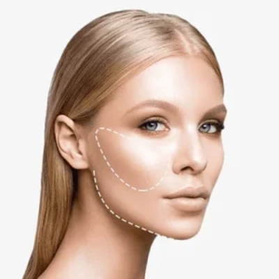 ClearLift laser