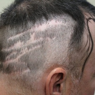 FUSS Hair Transplant