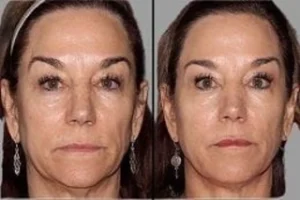 Fotona TwinLight® Fractional Rejuvenation 5 Fotona Twinlight Fractional Rejuvenation Before & After