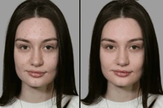 Freckles and Blemishes 5 Freckles and Blemishes Before & After