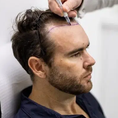 How Many Grafts Are Needed for a Crown Hair Transplant
