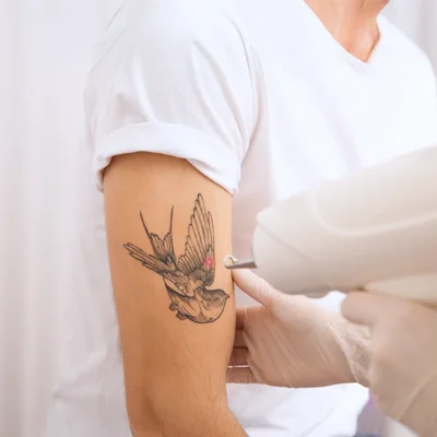 How Many Laser Sessions to Fully Remove a Tattoo? 1 How Many Laser Sessions to Fully Remove a Tattoo