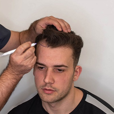 Hybrid Hair Transplant