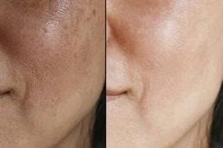 Large Pores Treatment 4 Large Pores Treatment Before & After