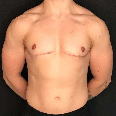 Lipo Chest Surgery Dubai