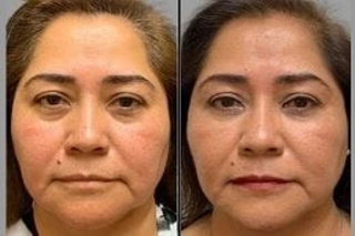 Micro Needling with PRP Therapy 4 Micro Needling PRP Therapy Before & After