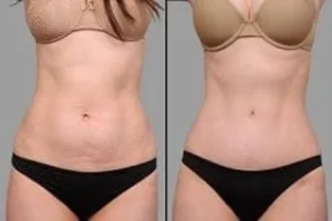 Stretch Marks Removal Before & After