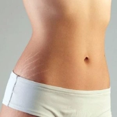 Stretch Marks Removal in Dubai