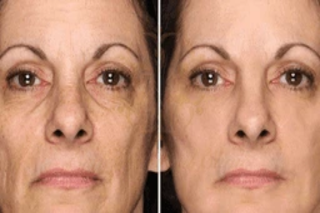 Anti Aging Treatments Before & After
