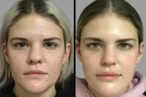 Before & After Acne Scars Treatment