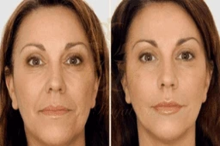 Before & After Anti Aging Treatments in Dubai