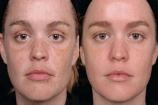Anti Aging Treatment 6 Before & After Anti Aging Treatments