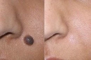 Before & After Benign Mole Removal in Dubai