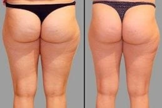 Cellulite Treatment 4 Before & After Cellulite Removal in Dubai