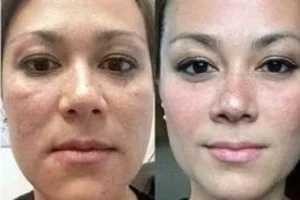 Concentrated Growth Factor 4 Before & After Concentrated Growth Factor in Dubai