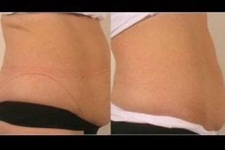 DMA Dynamic Muscle Activation 4 Before After DMA Dynamic Muscle Activation in Dubai