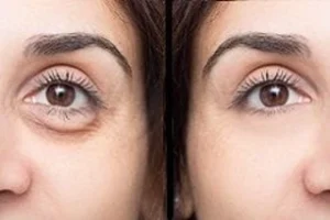 Before & After Dark Circles Treatment