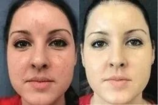 Deep Cleansing Facial 4 Before & After Deep Cleansing Facial in Dubai