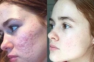 Before & After Derma Rollers Treatment in Dubai